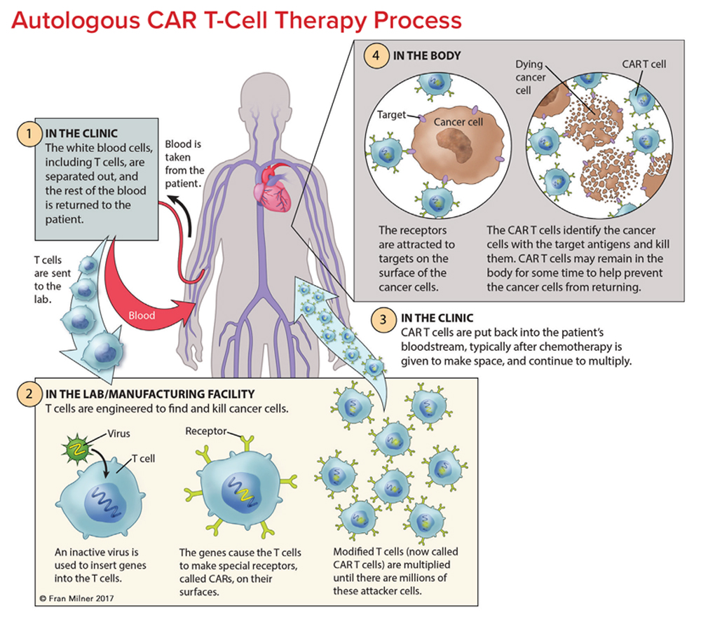 Chimeric Antigen Receptor Car T Cell Therapy Leukemia And Lymphoma