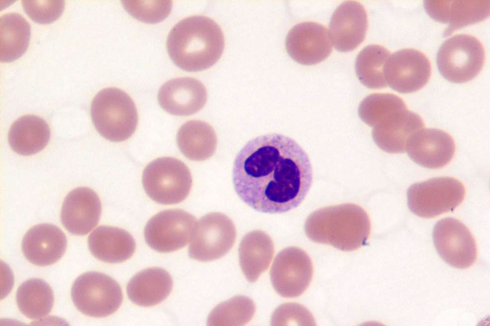 Myeloproliferative Neoplasms Research Funded by LLS